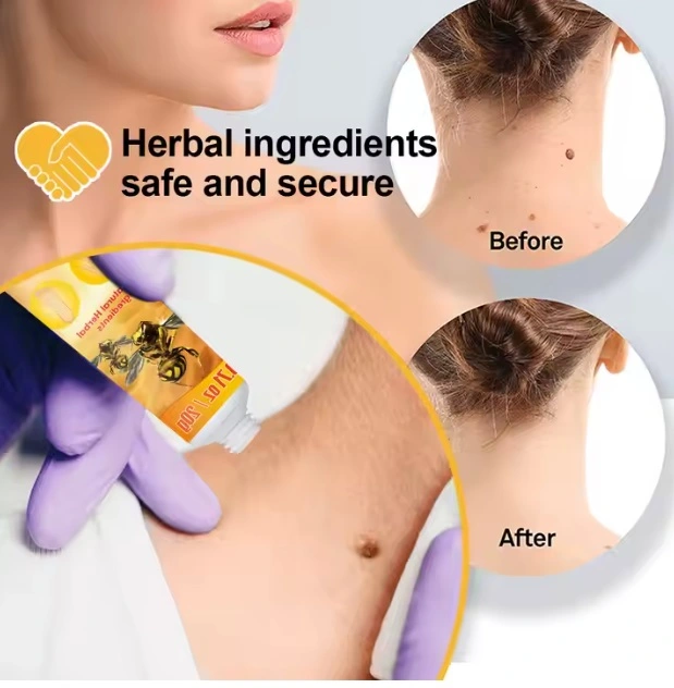 wart remover ointment